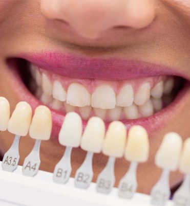 laminat-kaplama-tedavilerimiz-1