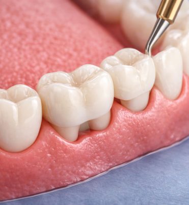 tedavilerimiz-dis-koprusu-1